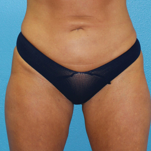 6 Months Post Bipolar RF + Liposuction Image