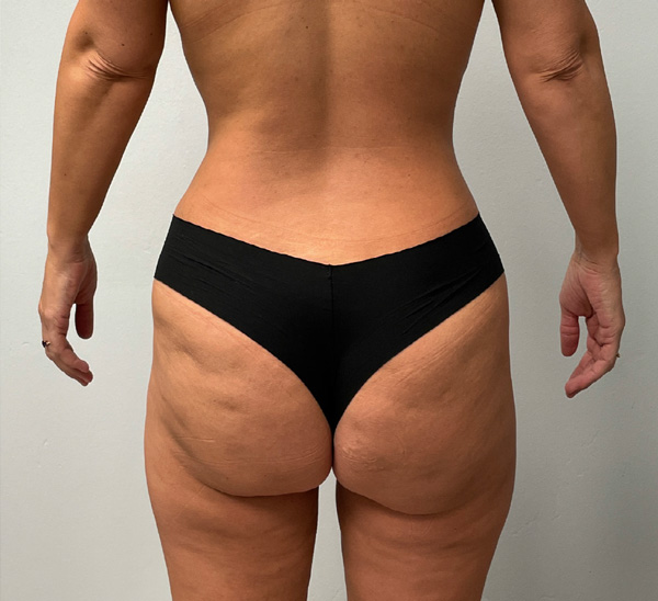3 Months Post-Op Image